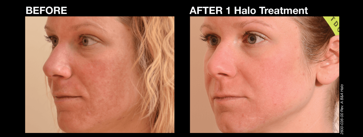 Dr.Khattab Halo Before and after