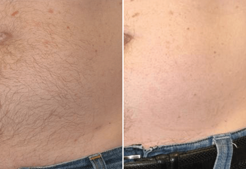 Hair Removal results