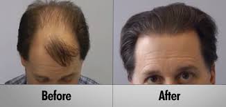 ARTAS hair transplant before & after