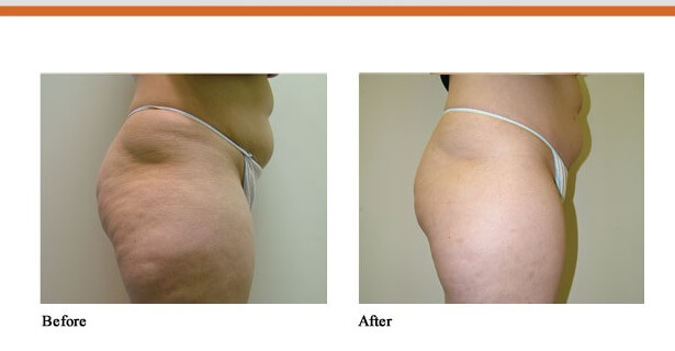 Cellulite treatment results