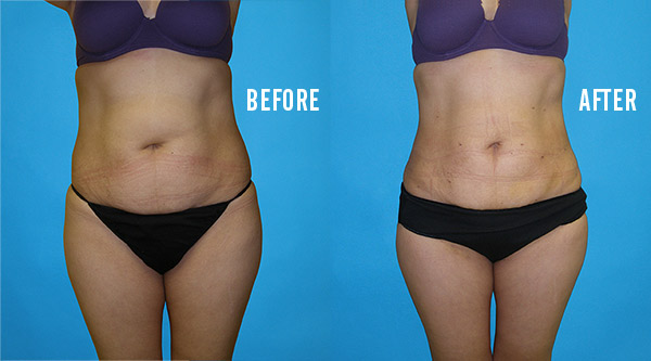 tumescent liposuction results