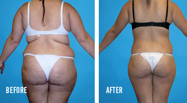 tumescent liposuction results 2