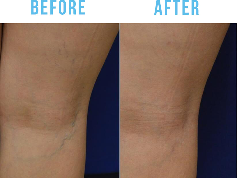 spider veins sacramento