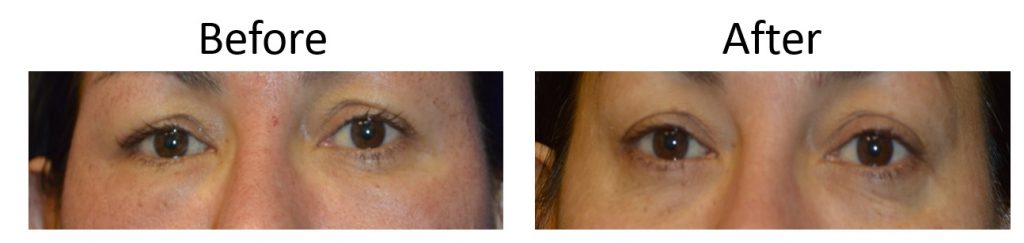 eyelid lift results