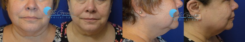 kybella double chin treatments