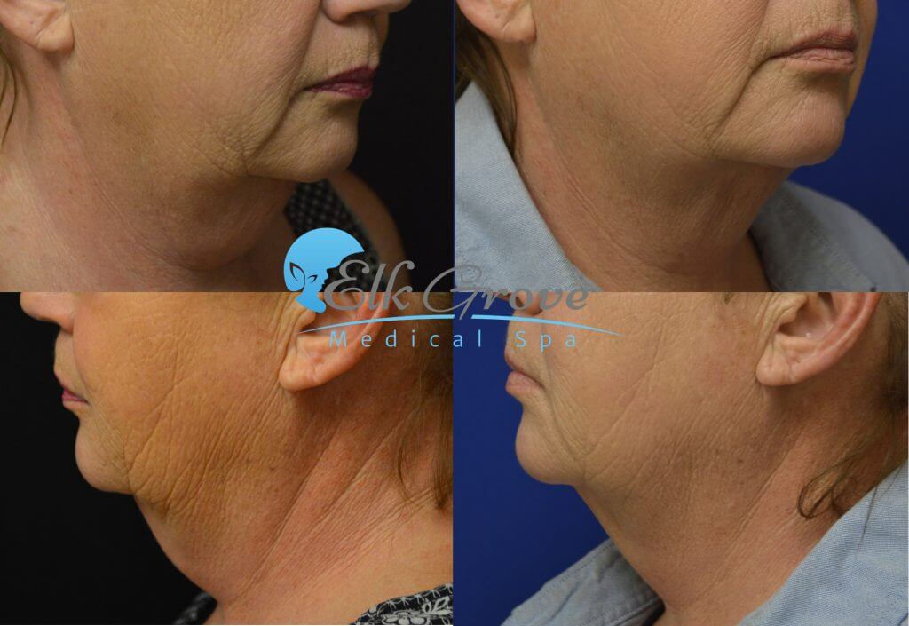 kybella double chin treatments