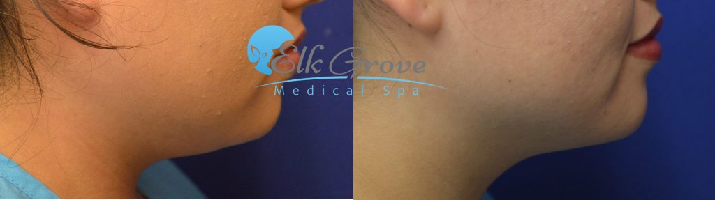 kybella double chin treatments