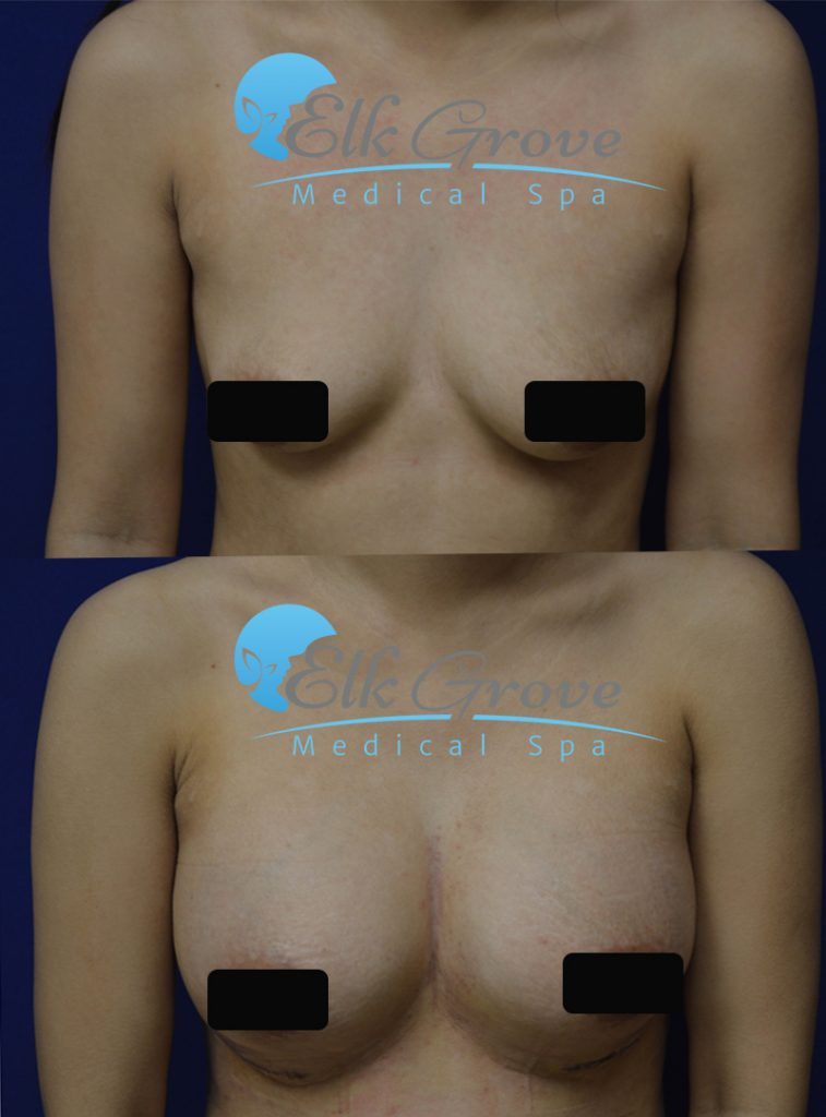 breast augmentation sacramento