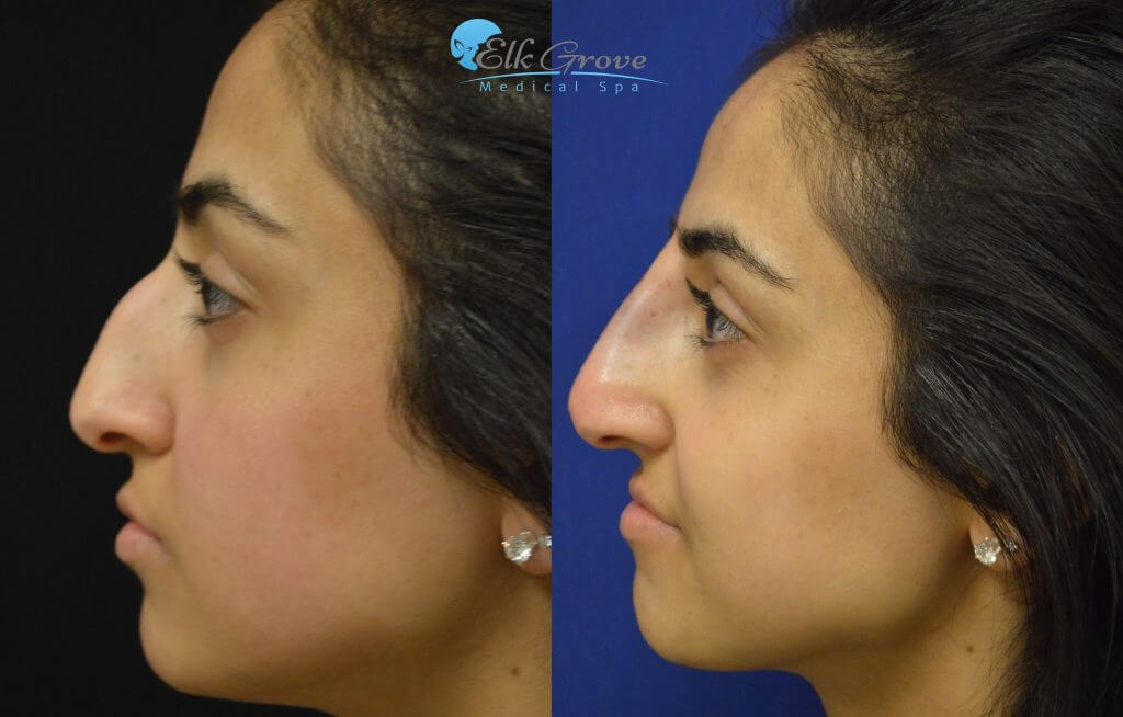 Rhinoplasty Patient Results