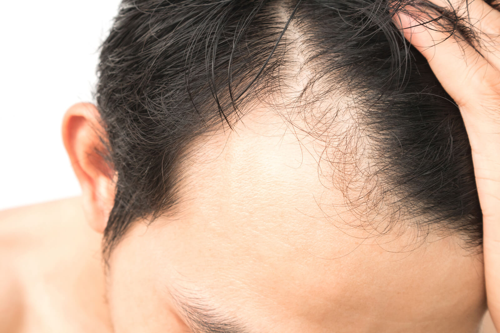 Benefits of the ARTAS® Robotic Hair Transplant