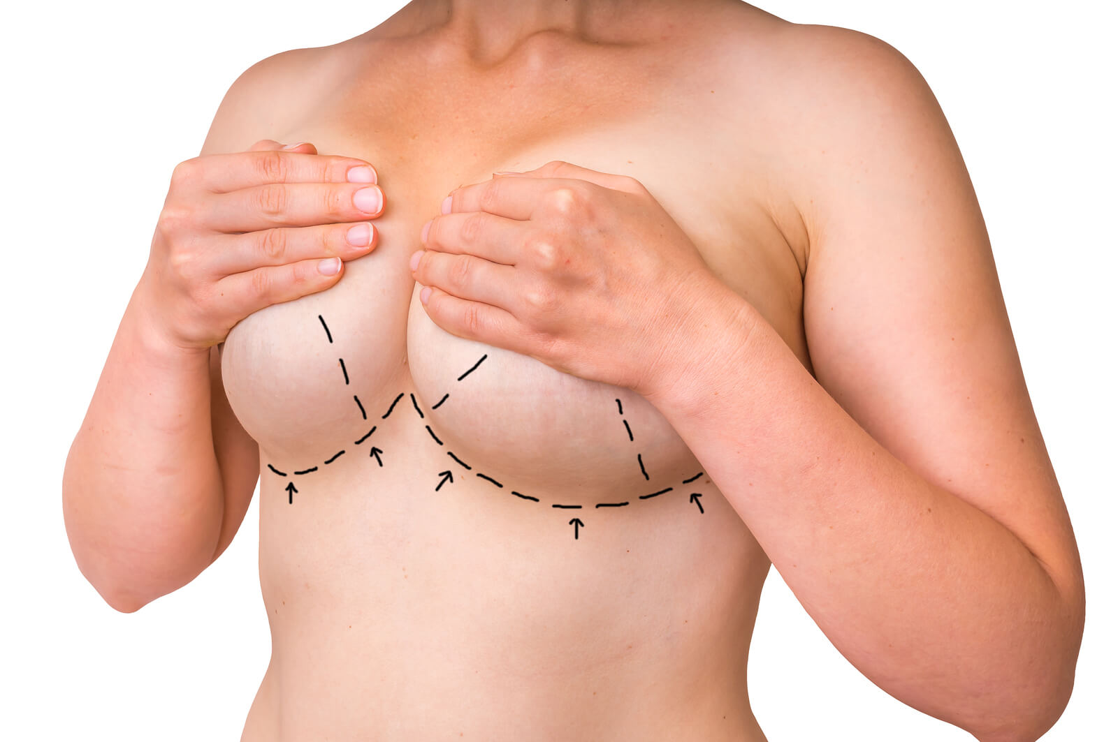 Harrington + Associates - 32A ⏭ 32C breast augmentation transformation to  give this patient a natural fullness. Feeling confident is the most  important thing, and if it's surgery you need, we are