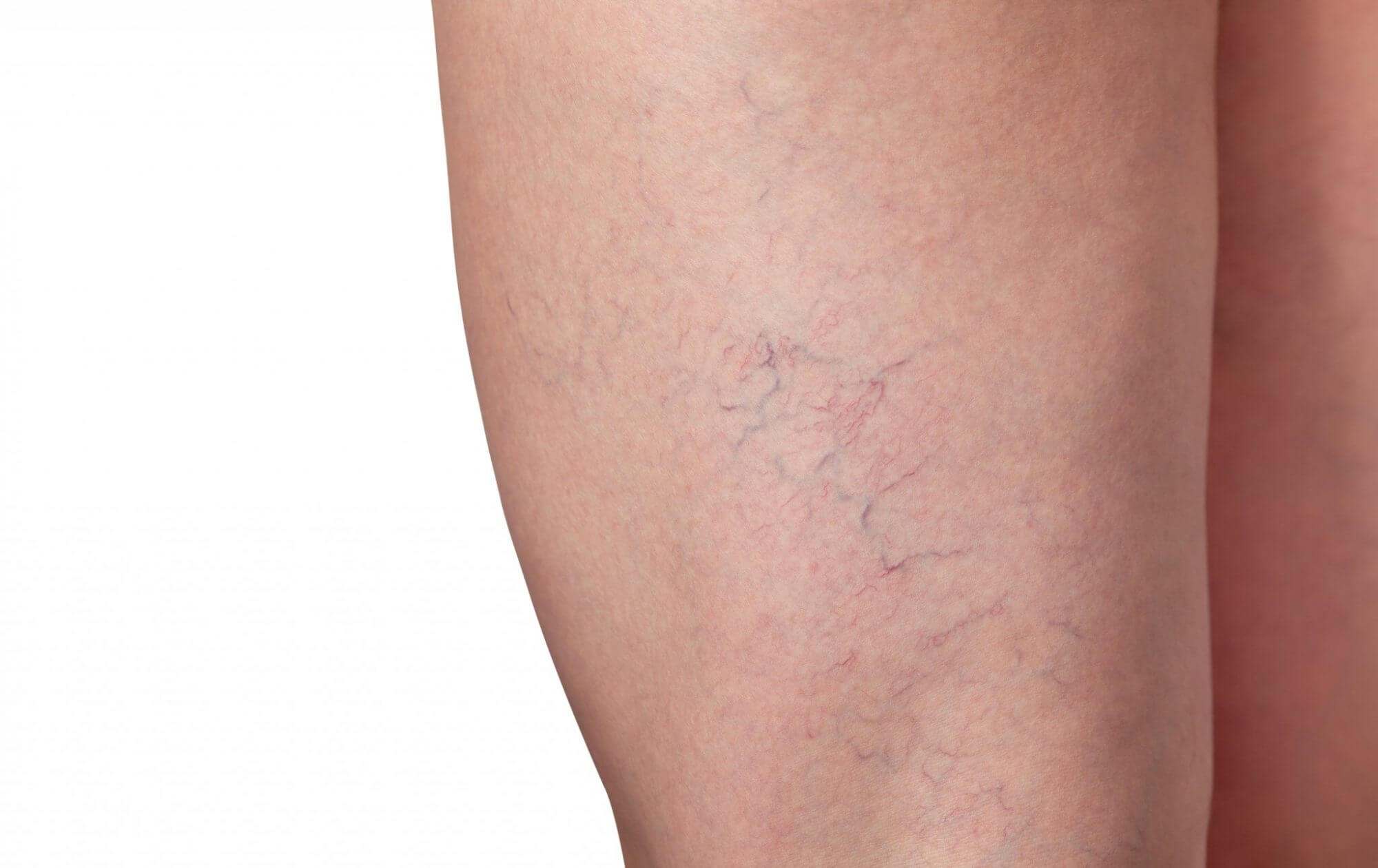 Spider Vein Treatment