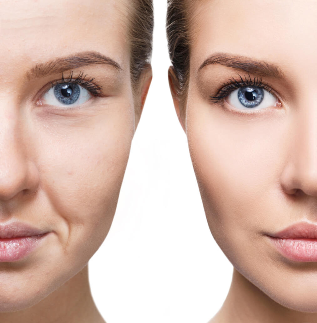 Wrinkle Treatments at Precision MD