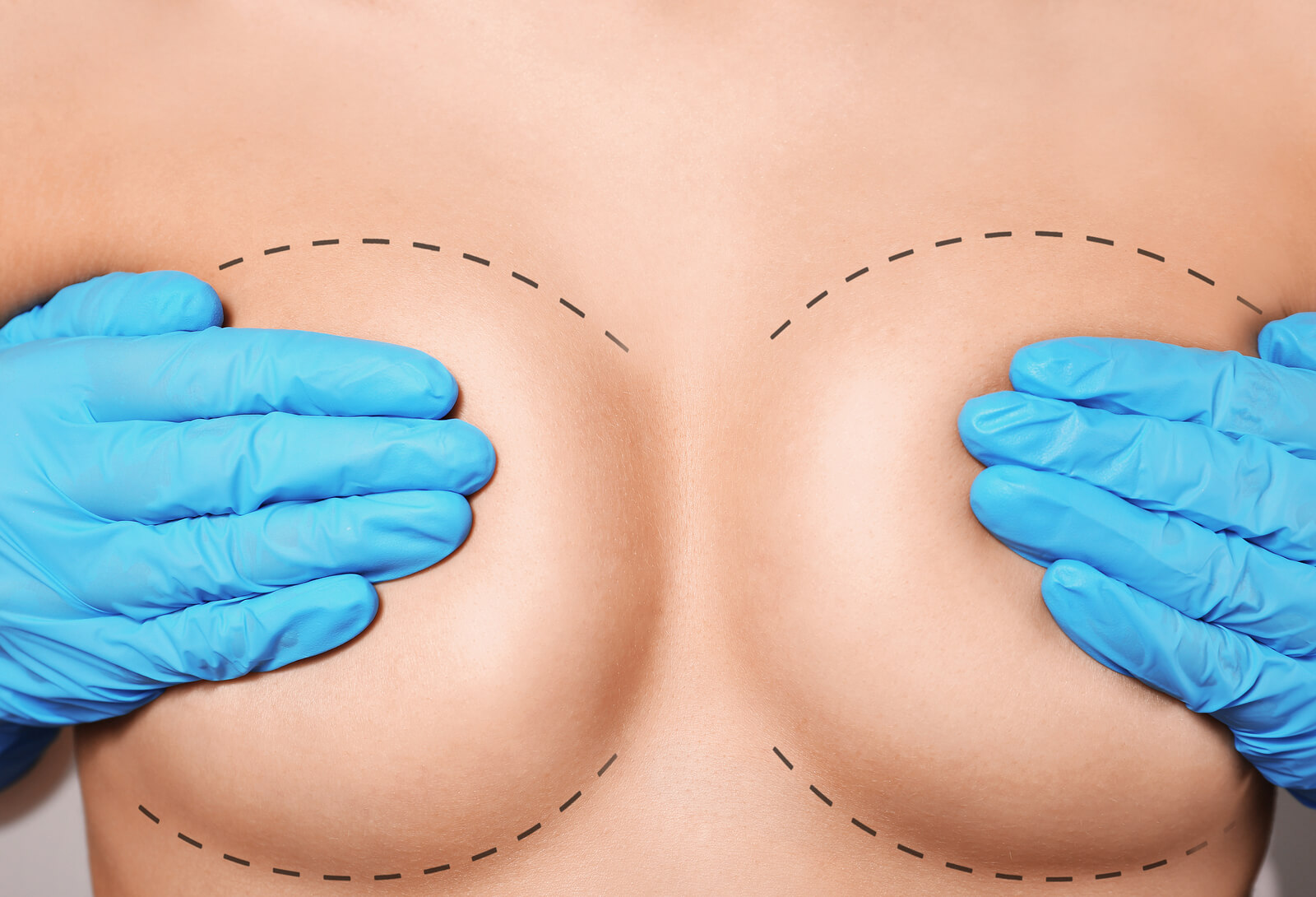 The Vampire Breast Lift