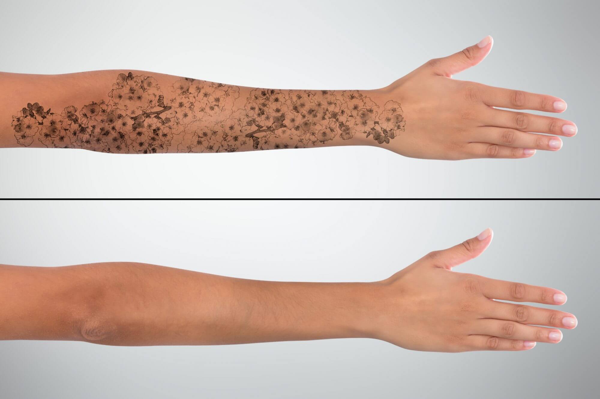 Laser Tattoo Removal  Genesis Medspa  Jefferson City Missouri