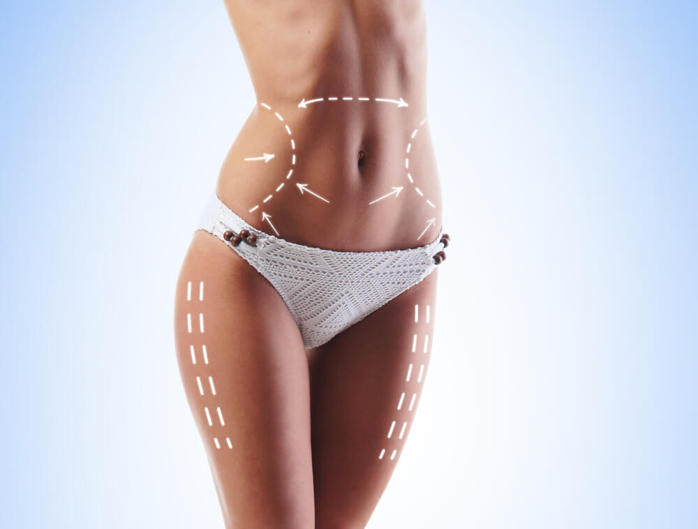 Body contouring procedure lines