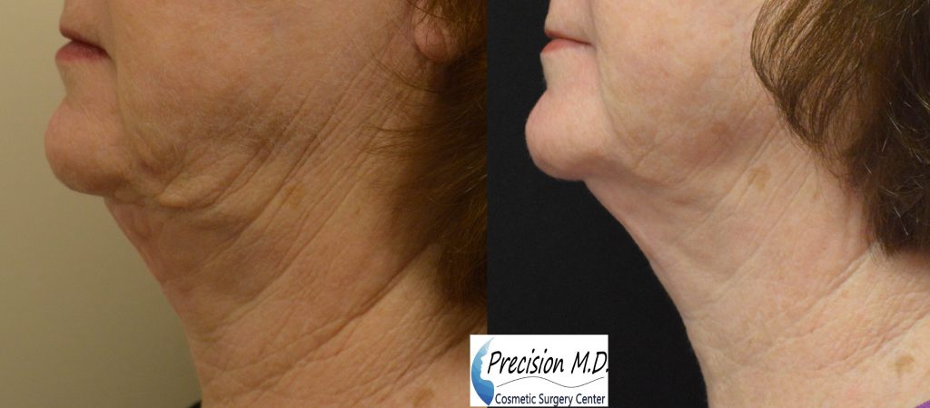 Neck Lift Results