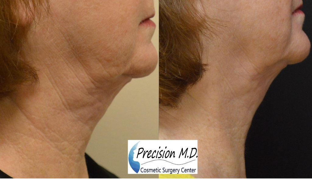 Neck Lift Results 3