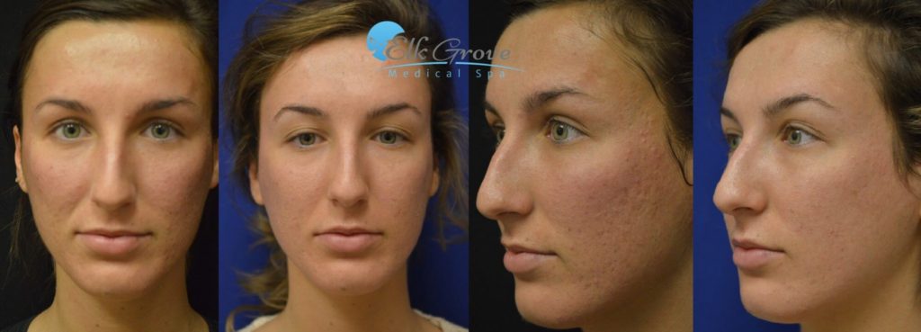 Acne treatment results