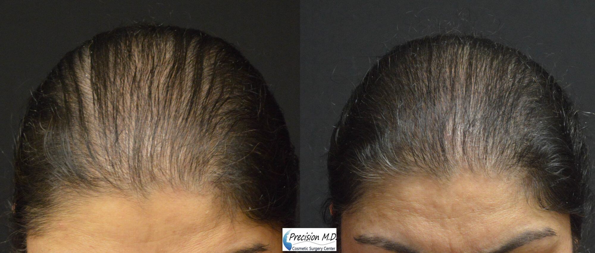Hair Restoration1