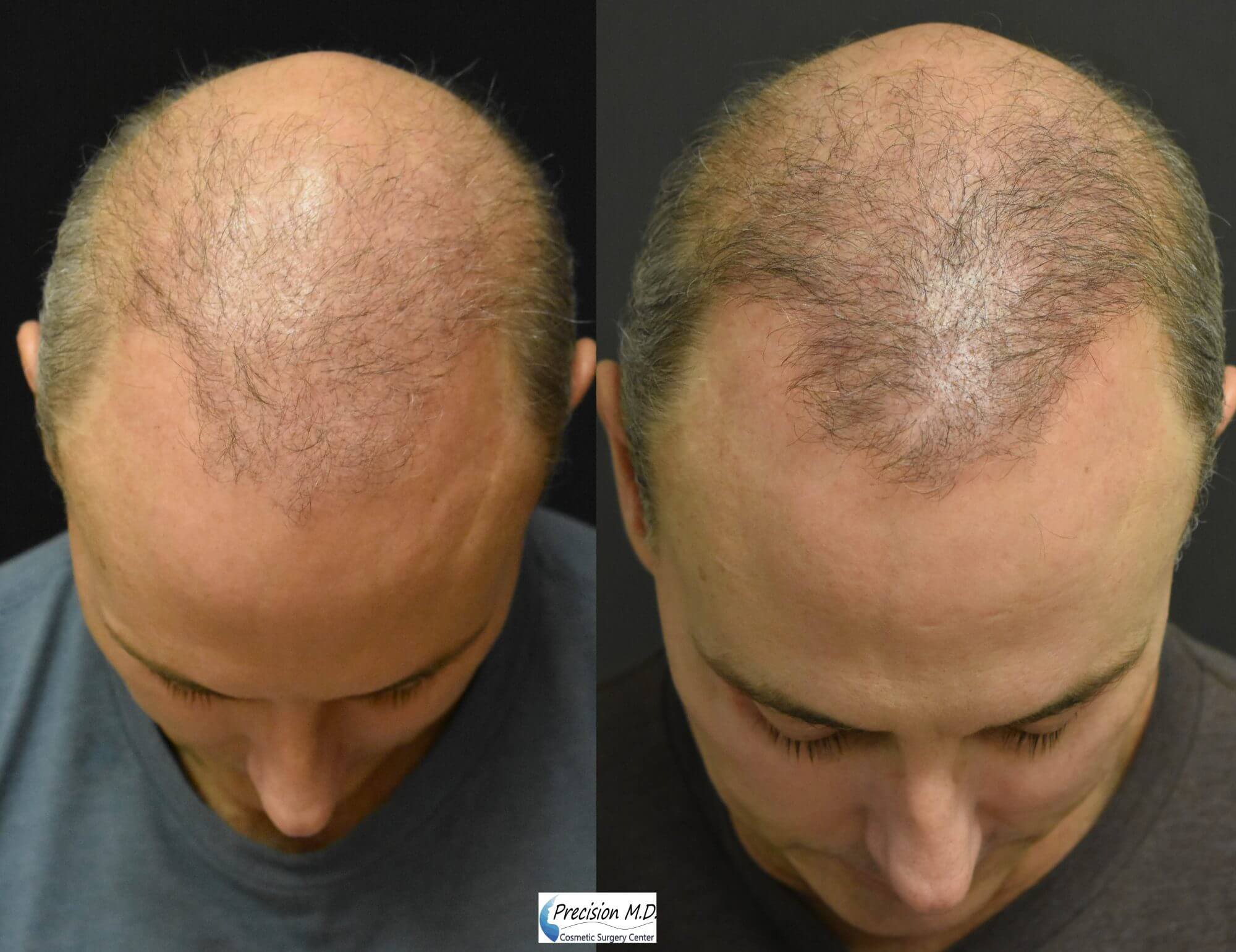 Hair Restoration