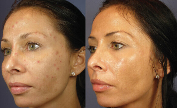 Before and after chemical peel treatment - PrecisionMD Cosmetic Surgery Center