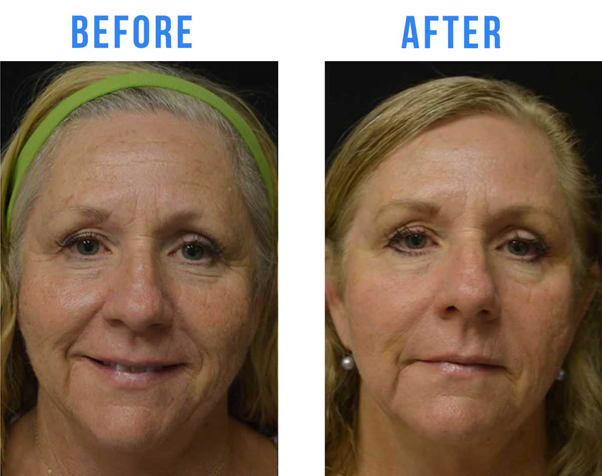 Before and After Age Spot Laser Treatment