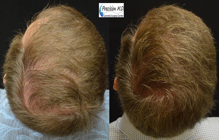 Before and After ARTAS Hair Transplant