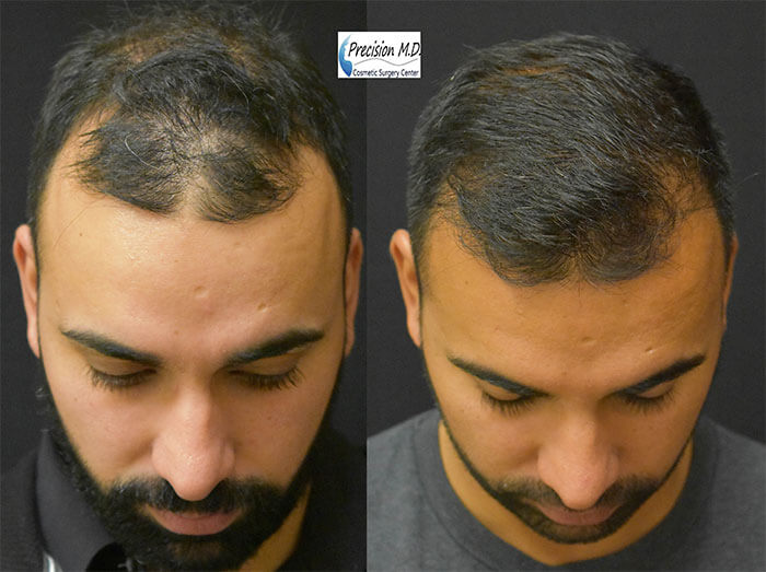 Before and After Hair Transplant