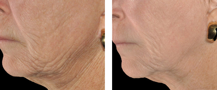 Before and after results - INFINI Wrinkle Treatment