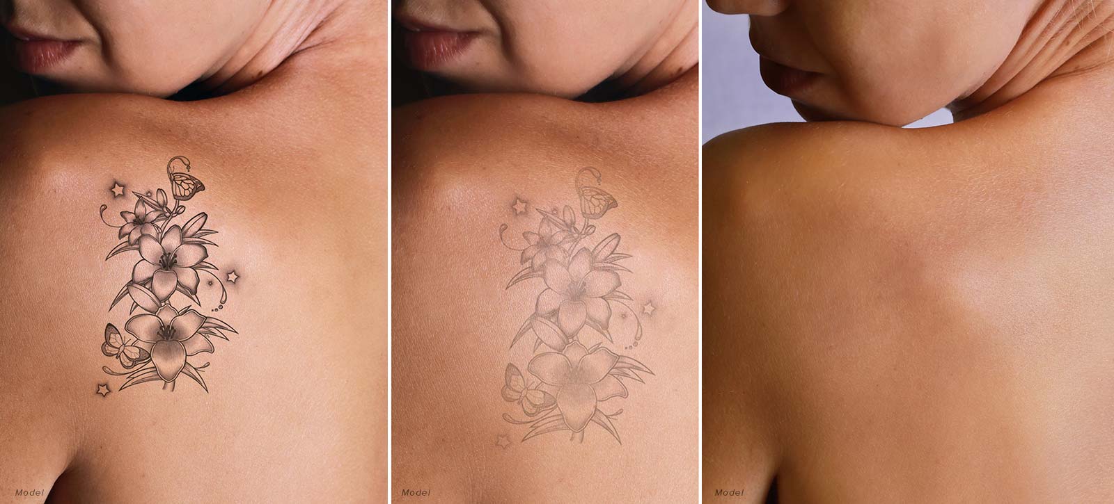 Tattoo removal new PicoWay laser for better results