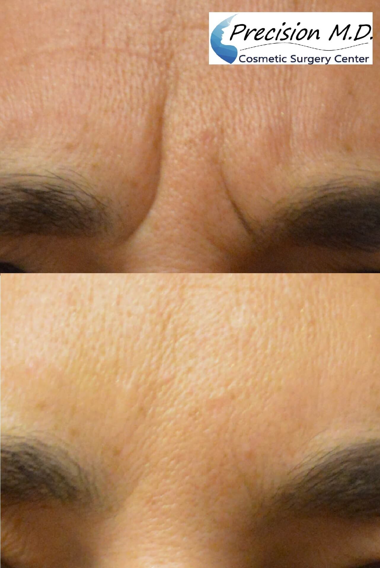 BOTOX before and after - Precision MD