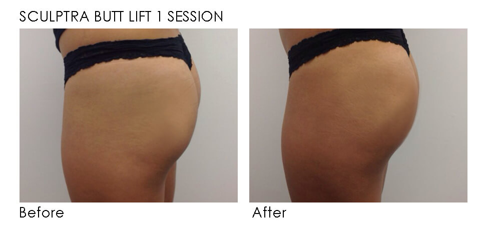 Sculptra butt lift before and after | Precision MD Sacramento, CA