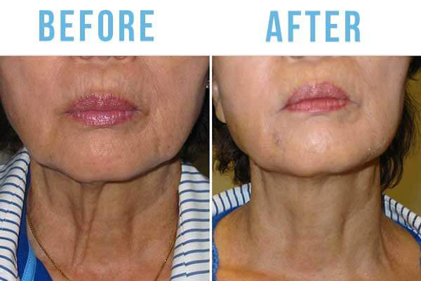 Skin Tightening Before and After