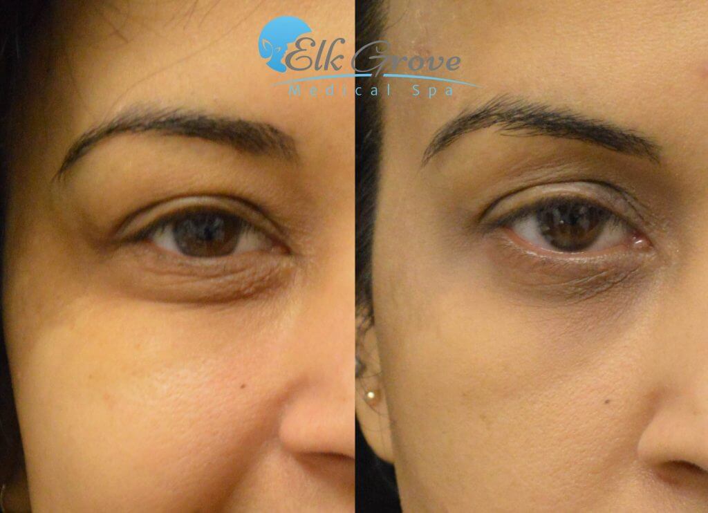 PRP Eye Bag Treatments Before and After