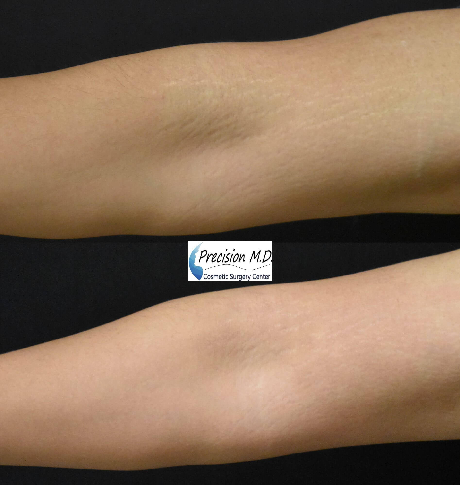 laser stretch mark removal