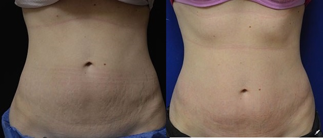 Stretch Marks Treatment before and after Infini