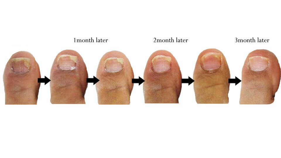 Toe Nail Fungus 3 Months post treatment