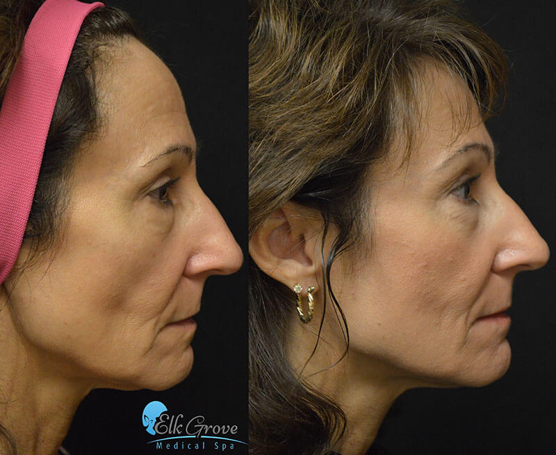 before and after ultherapy treatment on the face