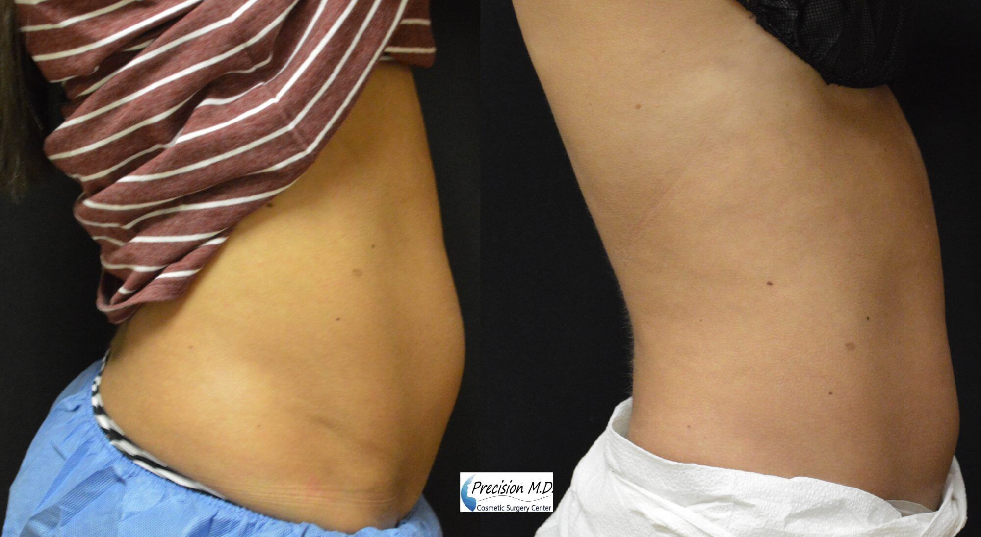 Before and After VelaShape Treatment | Precision MD Sacramento