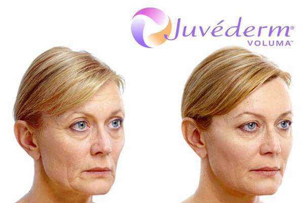 Juvéderm Voluma Before and After