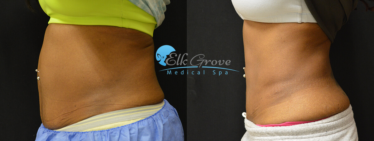 Before and after Coolsculpting treatment