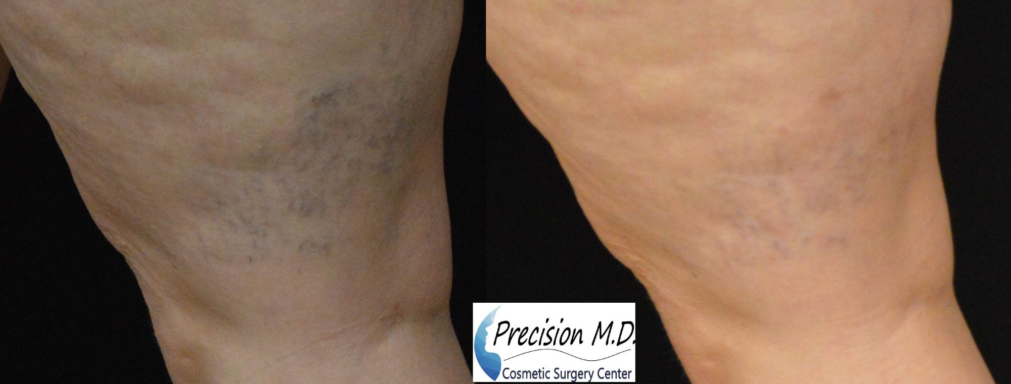 Spider Vein Treatment Before and after Sacramento, CA