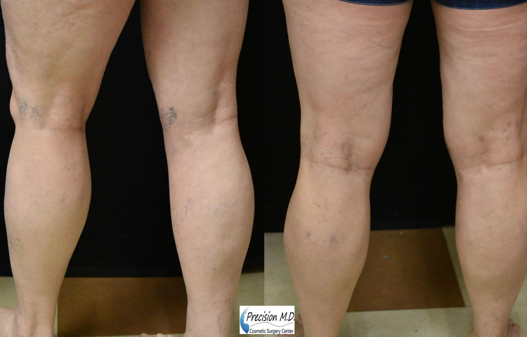 Spider Vein Treatment Before and after Sacramento, CA