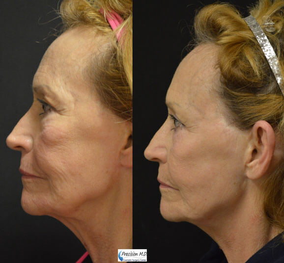 Nova Thread Lift Before and After Results 2